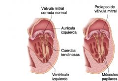 mitral V